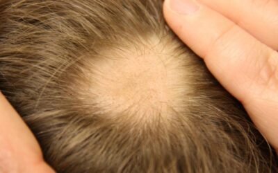 ALOPECIA AREATA