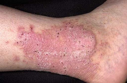 LICHEN PLANUS