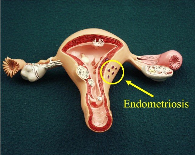 ENDOMETRIOSIS