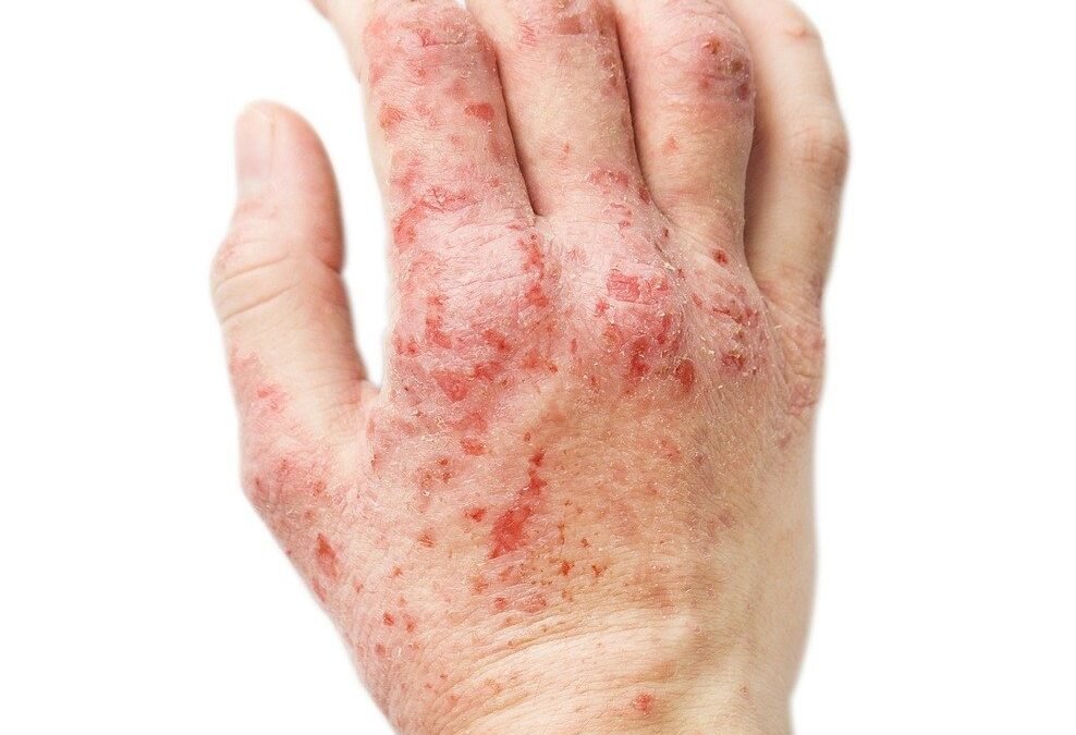 CONTACT DERMATITIS