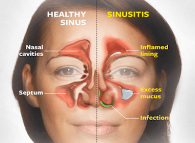 SINUSITIS