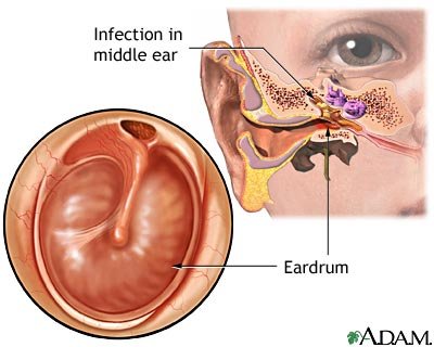 MIDDLE EAR INFECTIONS