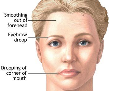 MYASTHENIA GRAVIS