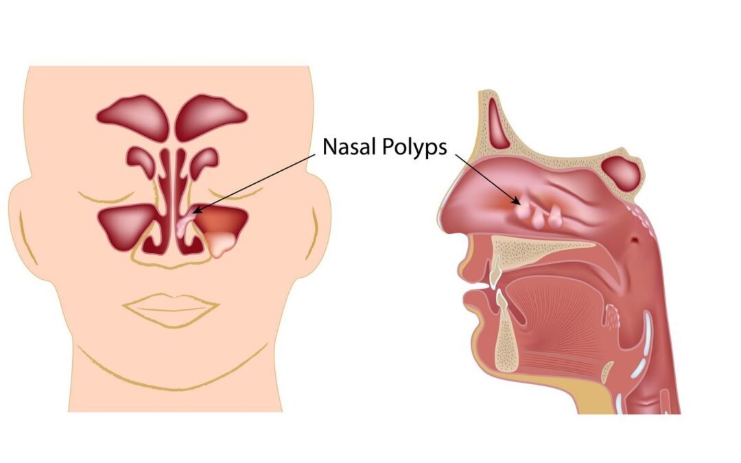 NASAL POLYP