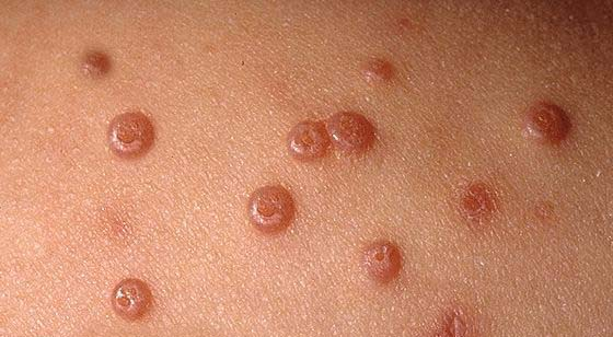 MOLLUSCUM CONTAGIOSUM